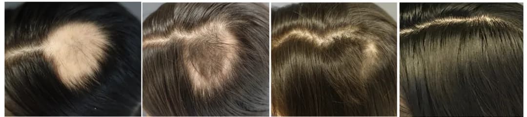 Four-stage progression showing hair regrowth along the part line with DE|RIVE hair restoration therapy