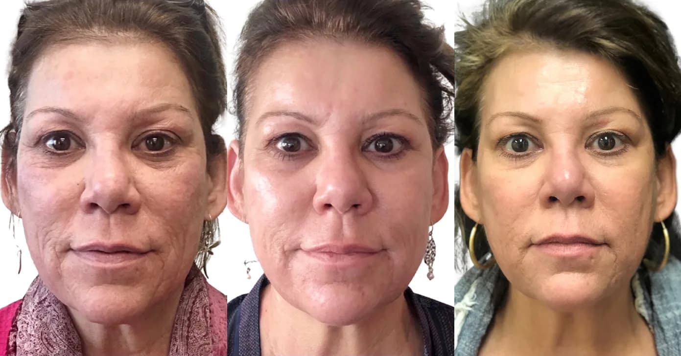 Progression of facial skin tone and firmness across a course of Scarlet SRF microneedling treatments