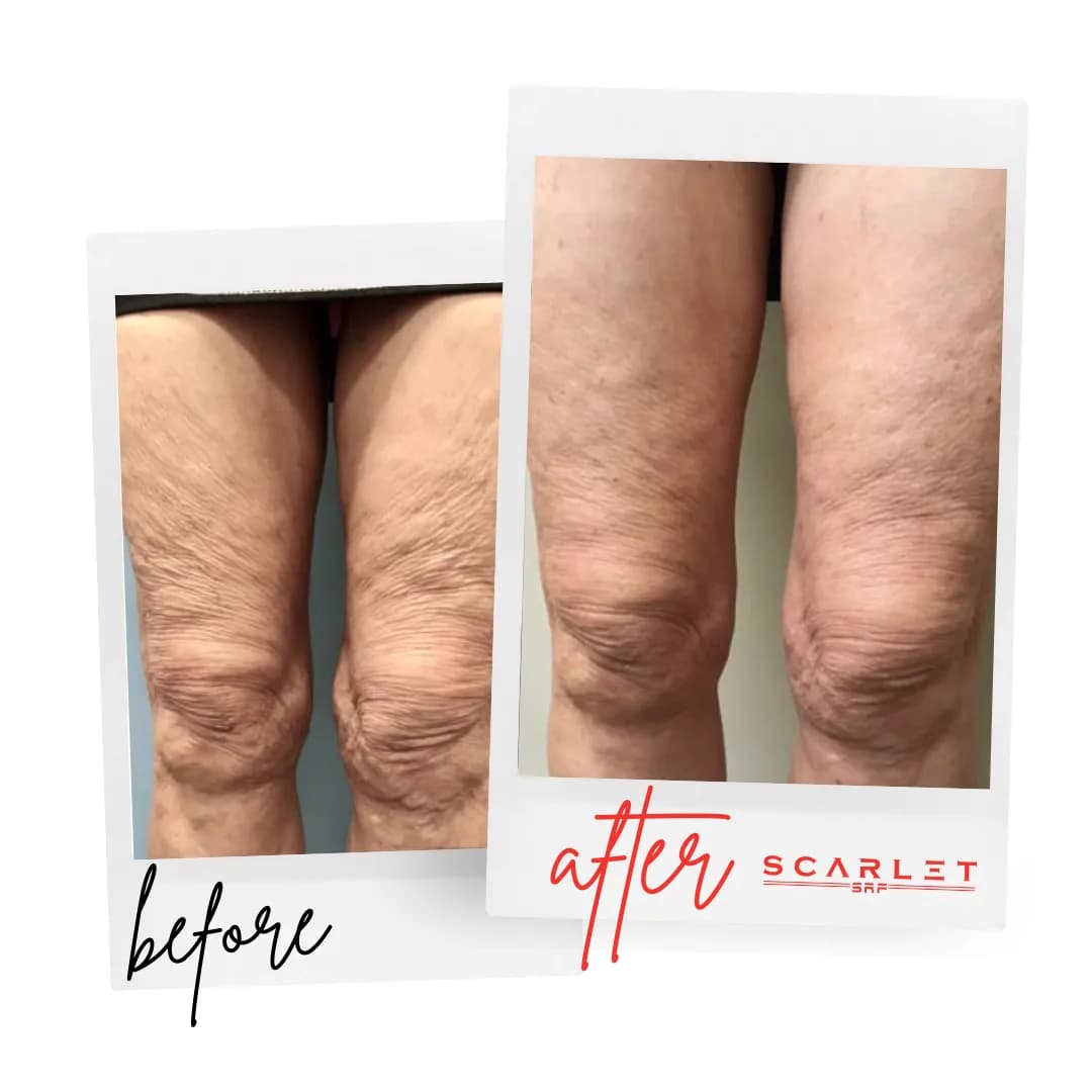 Before and after Scarlet SRF treatment showing tighter, smoother skin above the knees